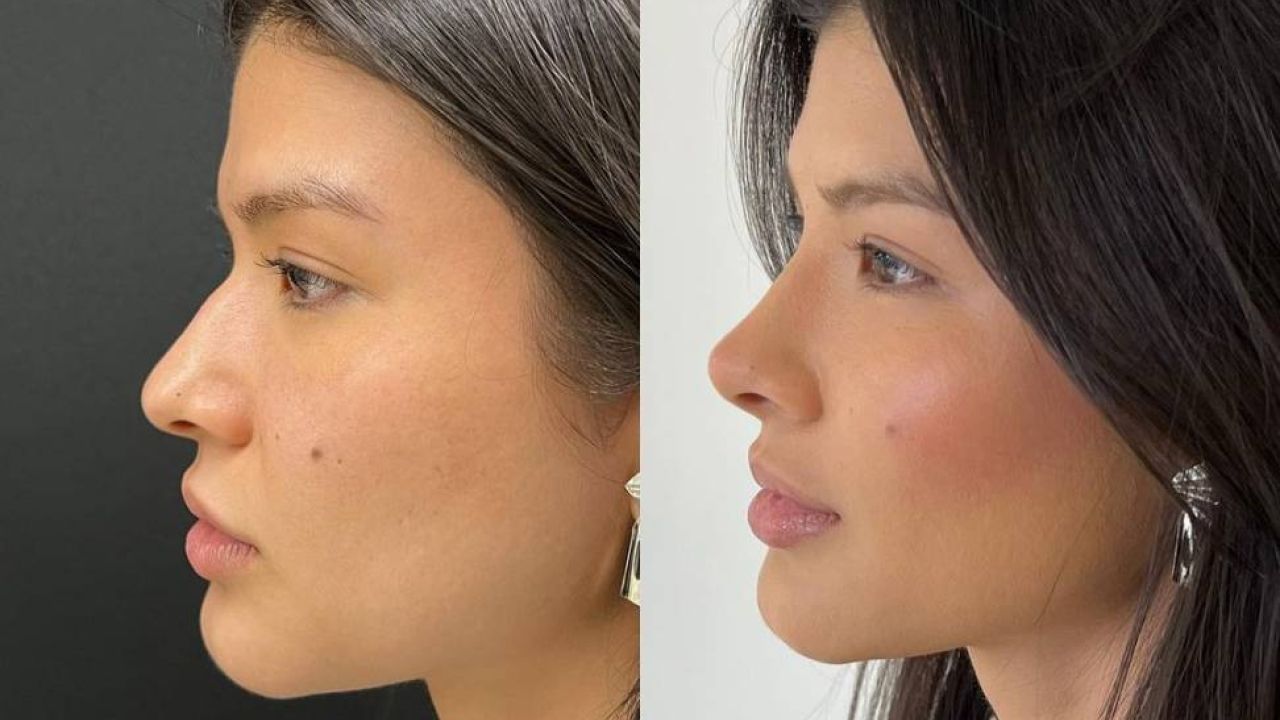 Full Face Antes e Depois