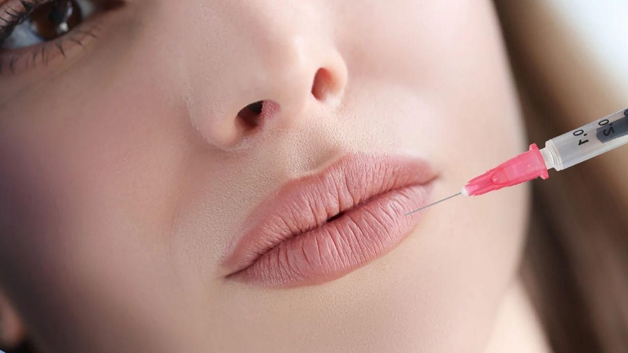 Preenchimento Labial 1 ml