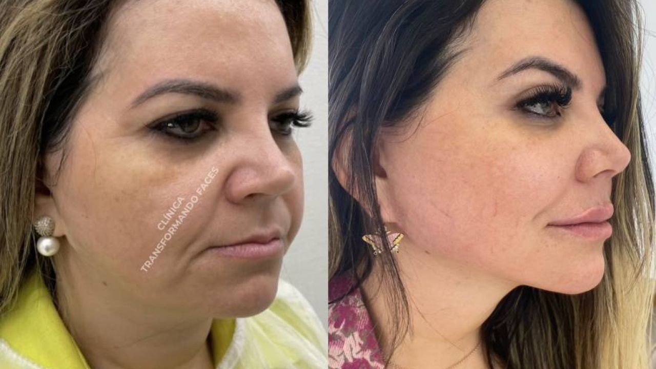 Harmonização Facial Valor