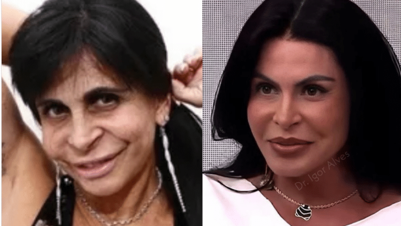Onde Gretchen fez Harmonização Facial