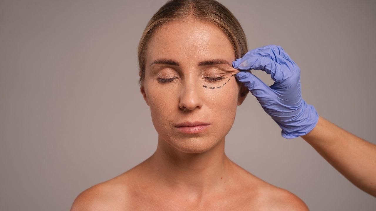 Blefaroplastia