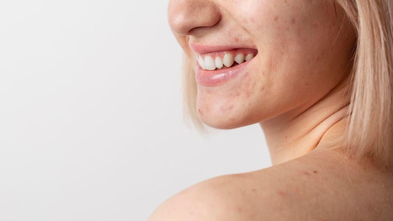 Cicatrizes de acne
