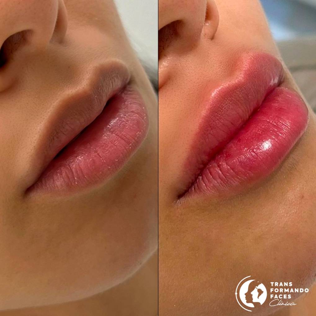 Preenchimento Labial Preenchimento Labial