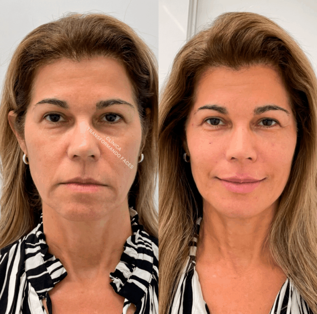 Harmonização Facial Harmonização Facial