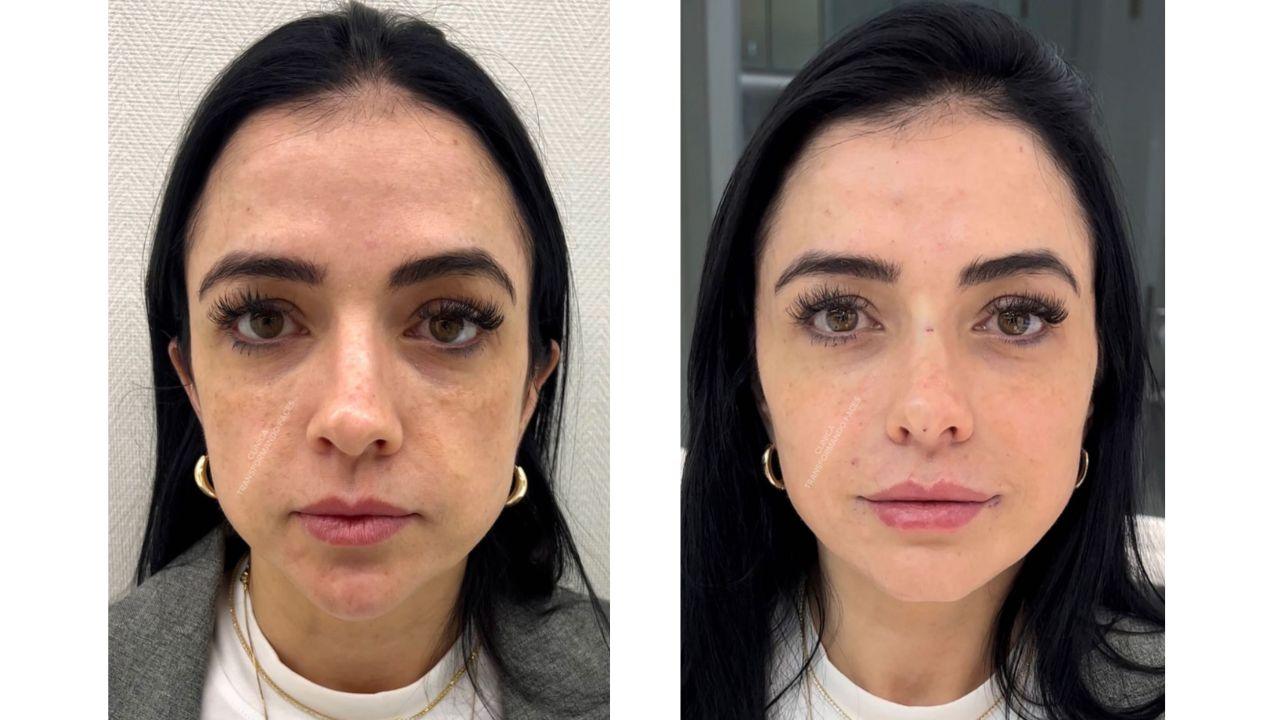 full face antes e depois full face antes e depois