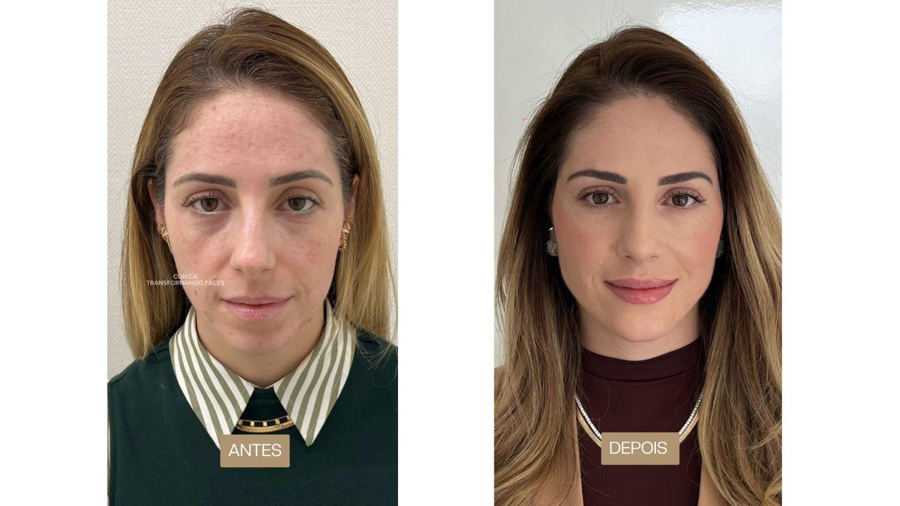 full face antes e depois full face antes e depois