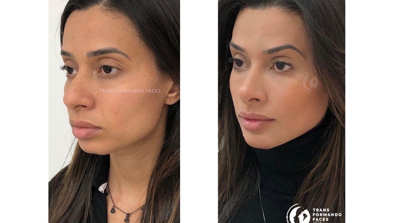 full face antes e depois full face antes e depois