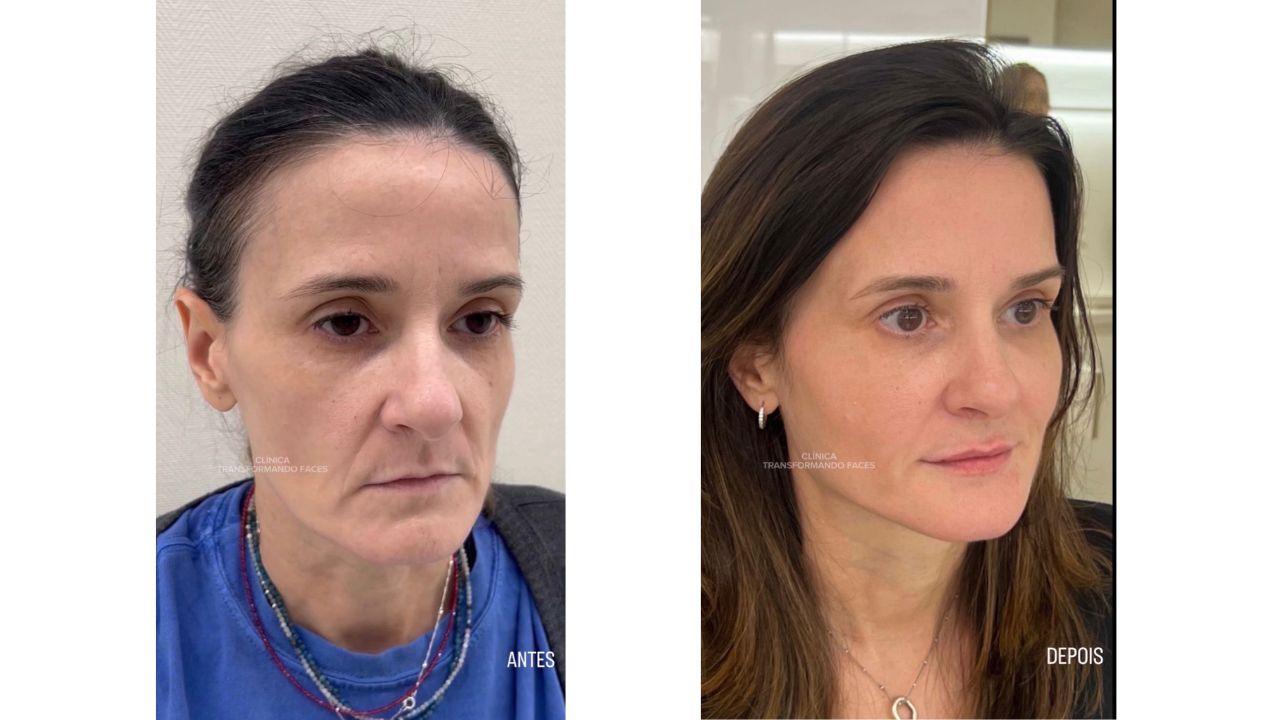full face antes e depois full face antes e depois