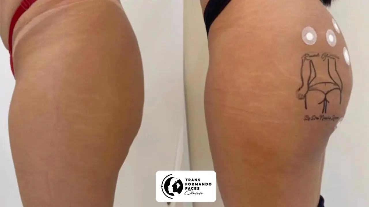 Bumbum Up Lift antes e depois Bumbum Up Lift antes e depois