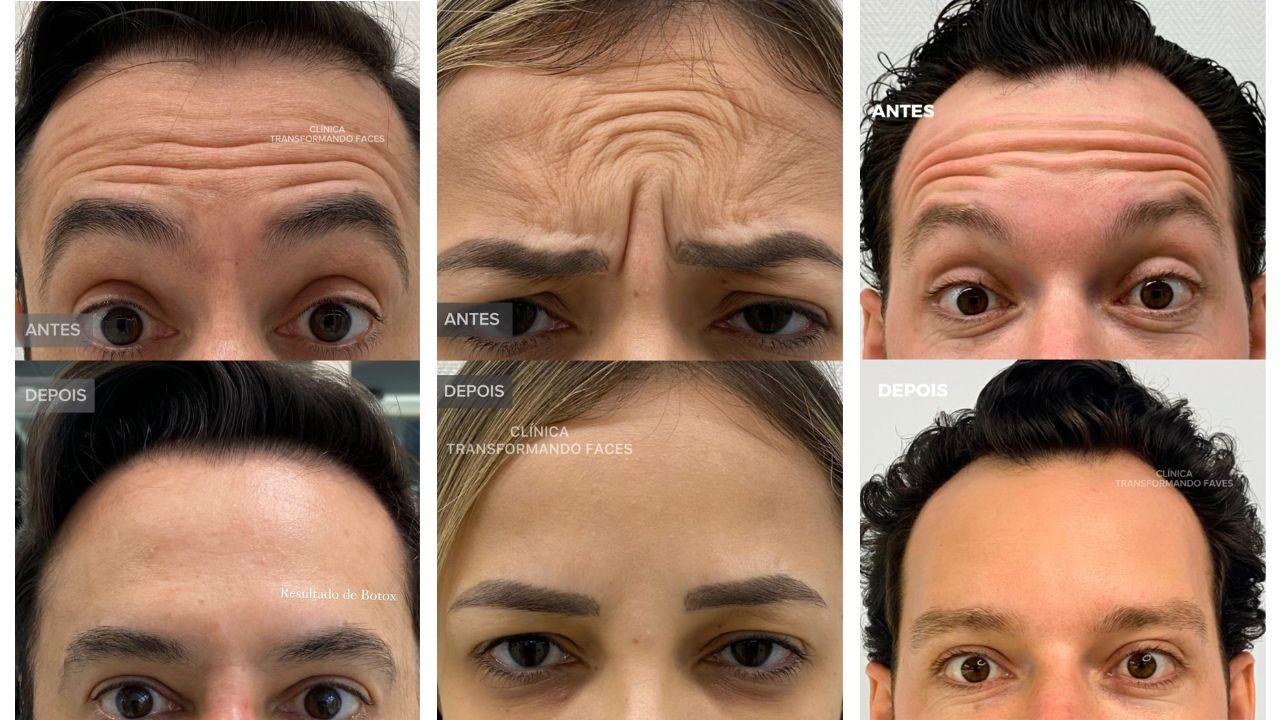 Botox no rosto antes e depois Botox no rosto antes e depois