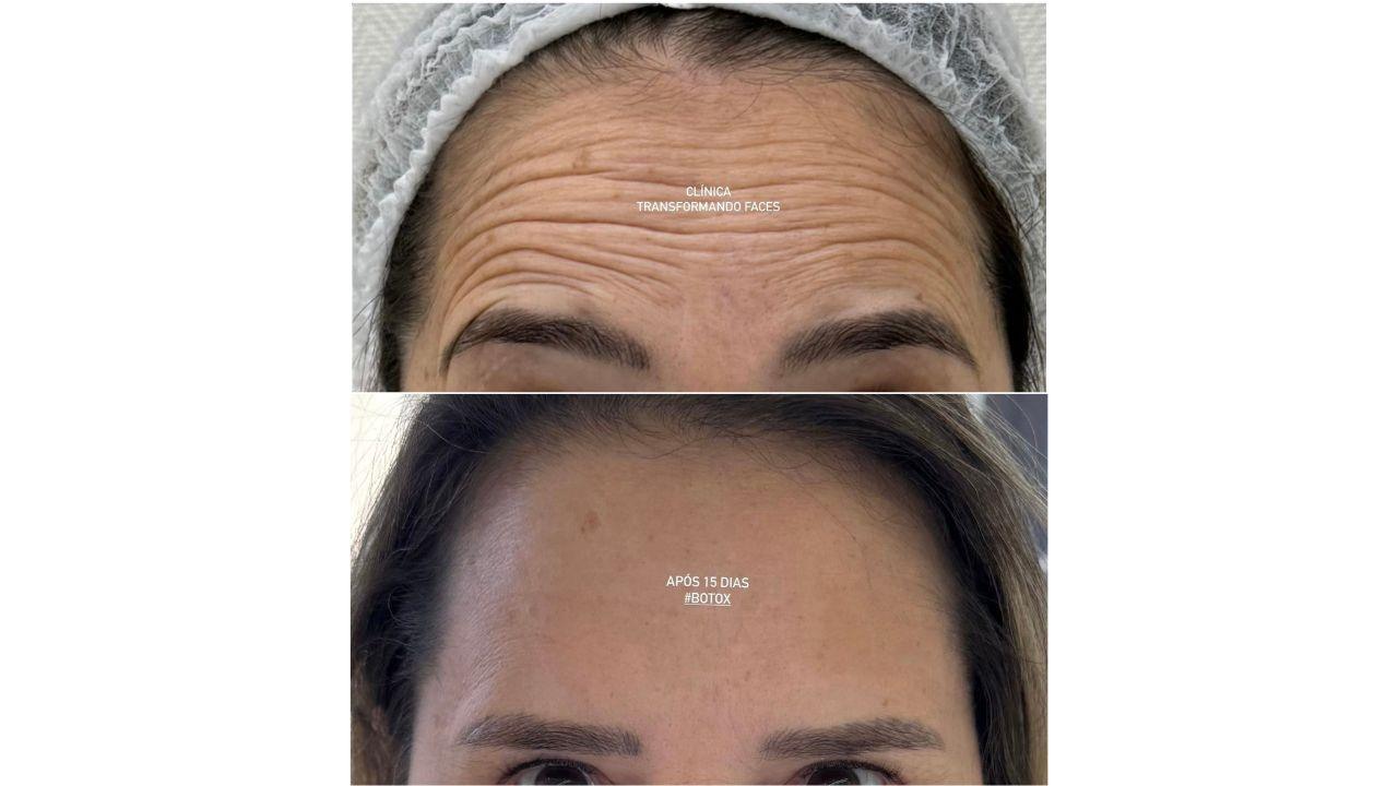 Botox no rosto antes e depois Botox no rosto antes e depois