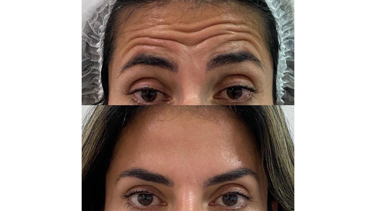 Botox antes e depois Botox antes e depois