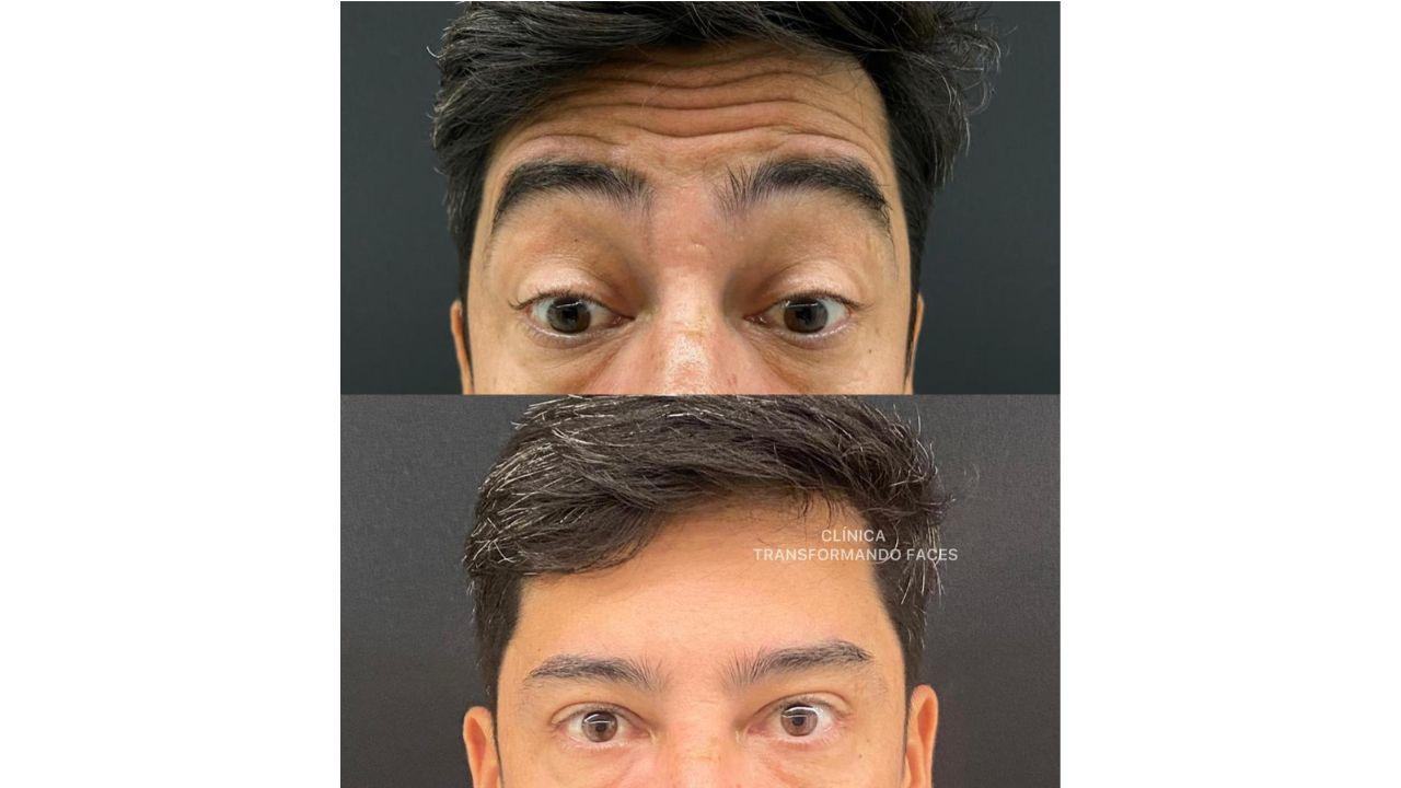 Botox antes e depois Botox antes e depois
