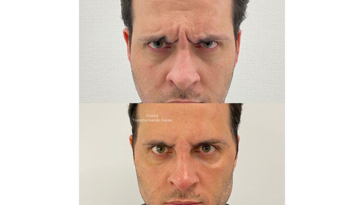 Botox antes e depois