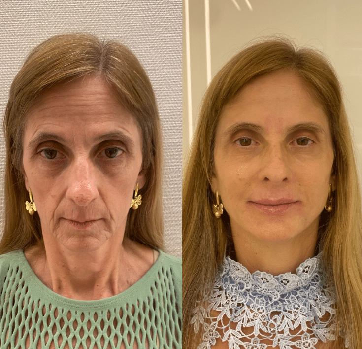 Full face valor