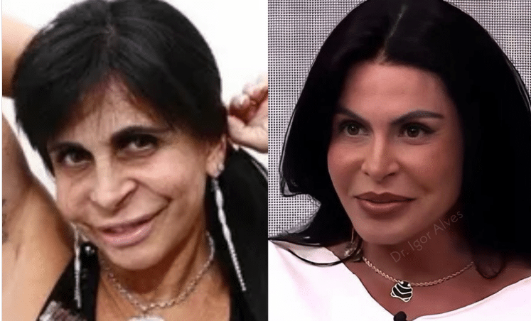 Onde Gretchen fez Harmonização Facial