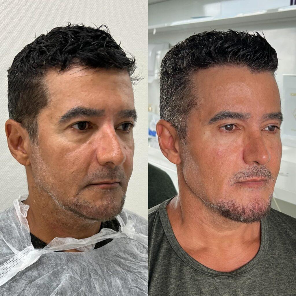 Preenchimento de Mandíbula Preenchimento de Mandíbula