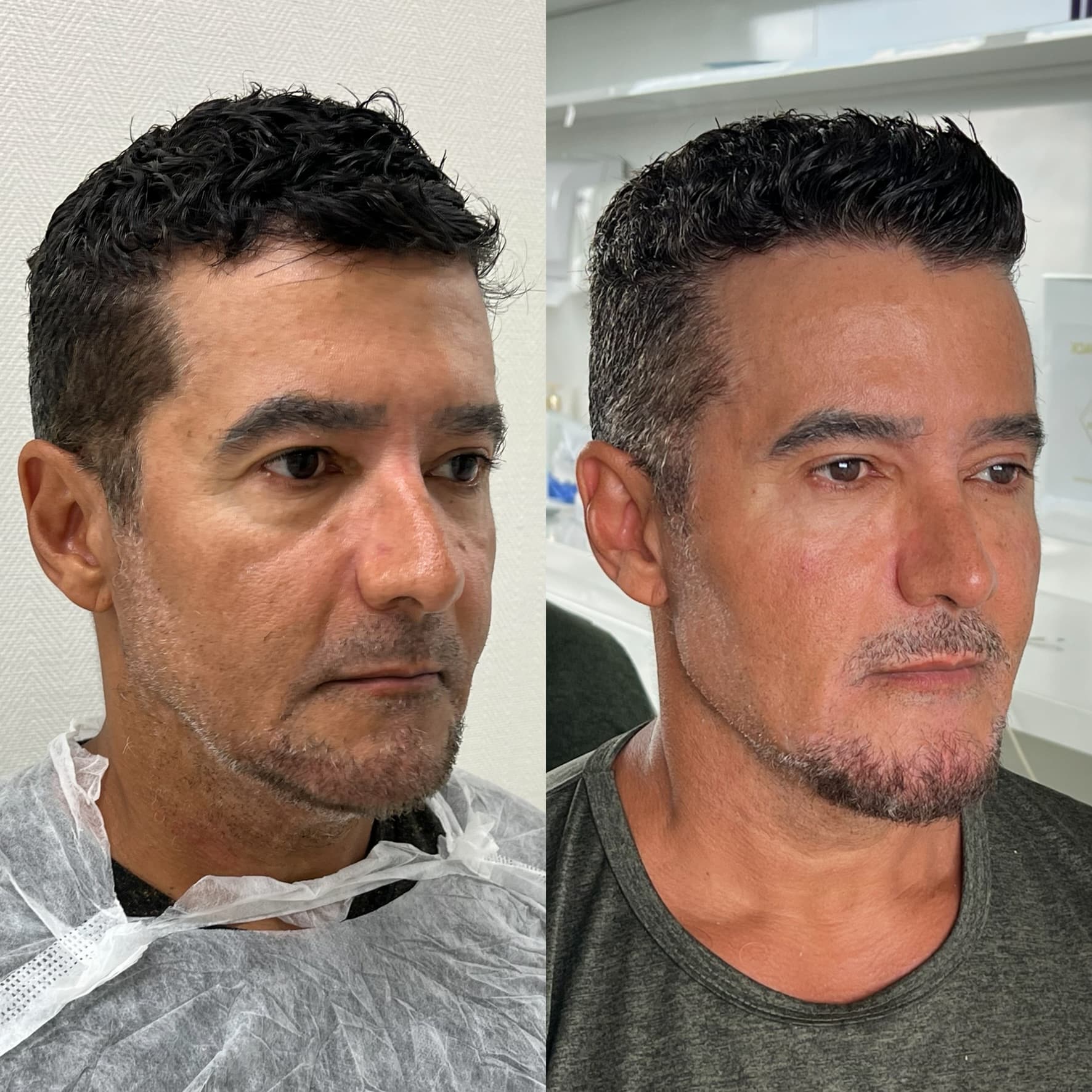 Preenchimento de Mandíbula