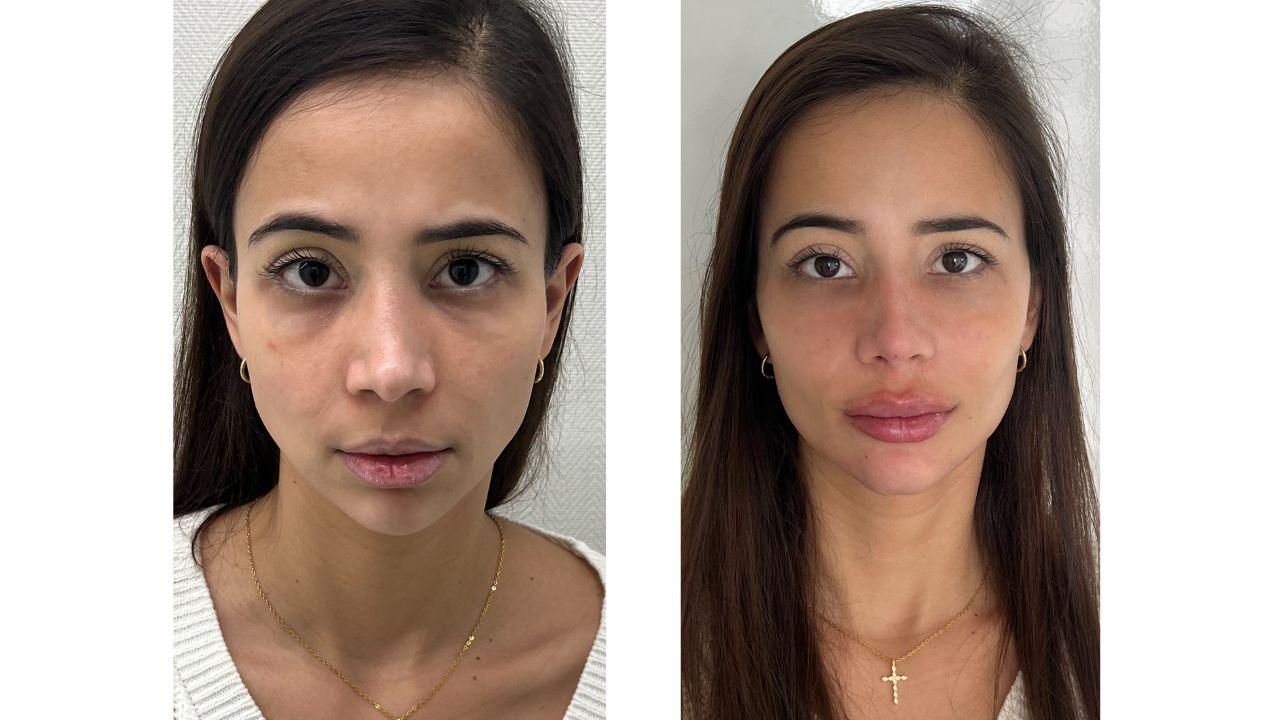 Preenchimento facial antes e depois Preenchimento facial antes e depois