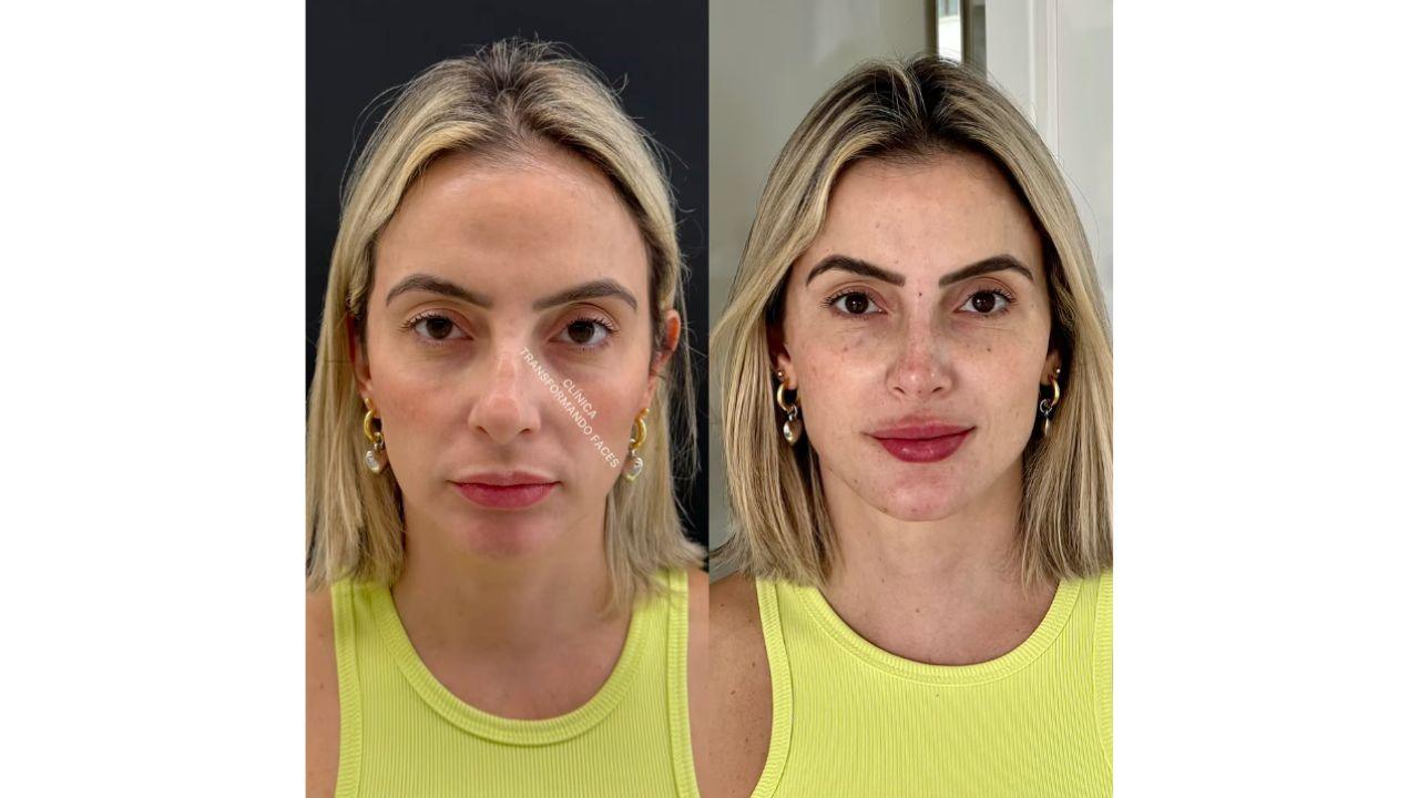 Preenchimento facial antes e depois Preenchimento facial antes e depois