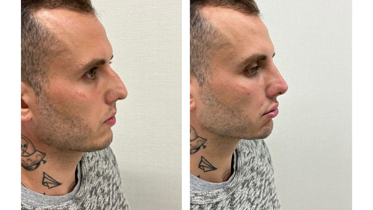 Rinomodelação antes e depois Rinomodelação antes e depois