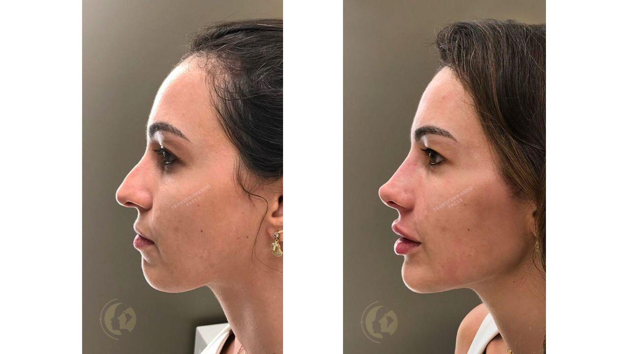 Rinomodelação com ácido hialurônico antes e depois Rinomodelação com ácido hialurônico antes e depois
