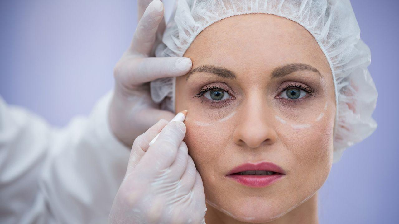 blefaroplastia antes e depois blefaroplastia antes e depois