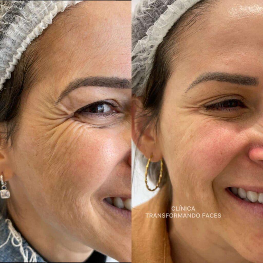 botox antes e depois botox antes e depois