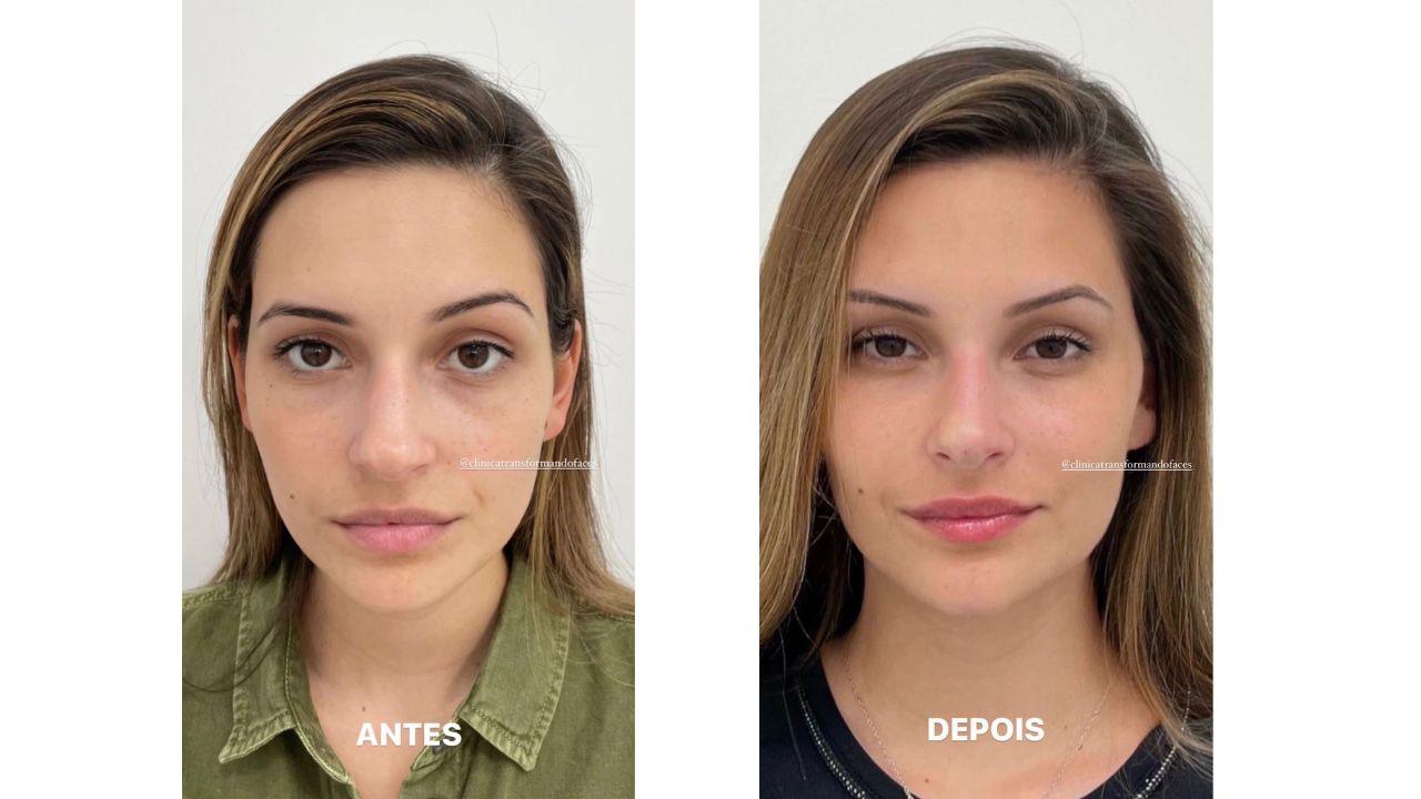 full face antes e depois full face antes e depois