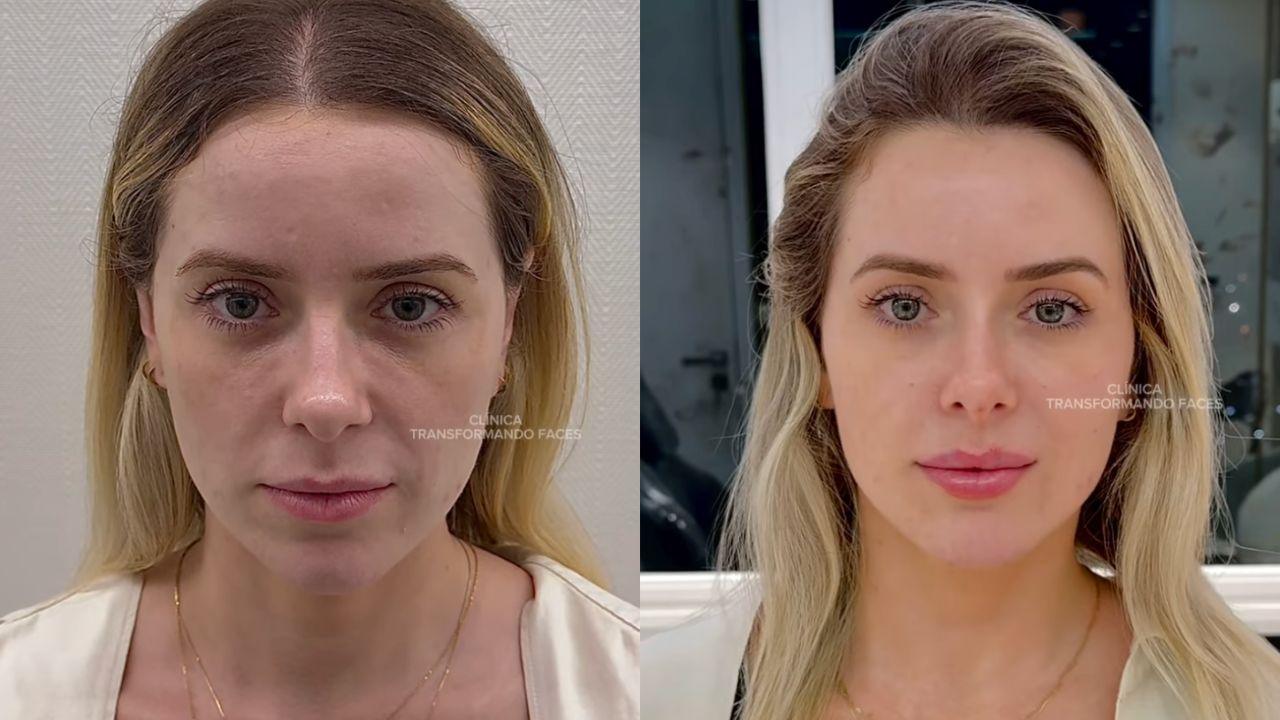 full face antes e depois full face antes e depois