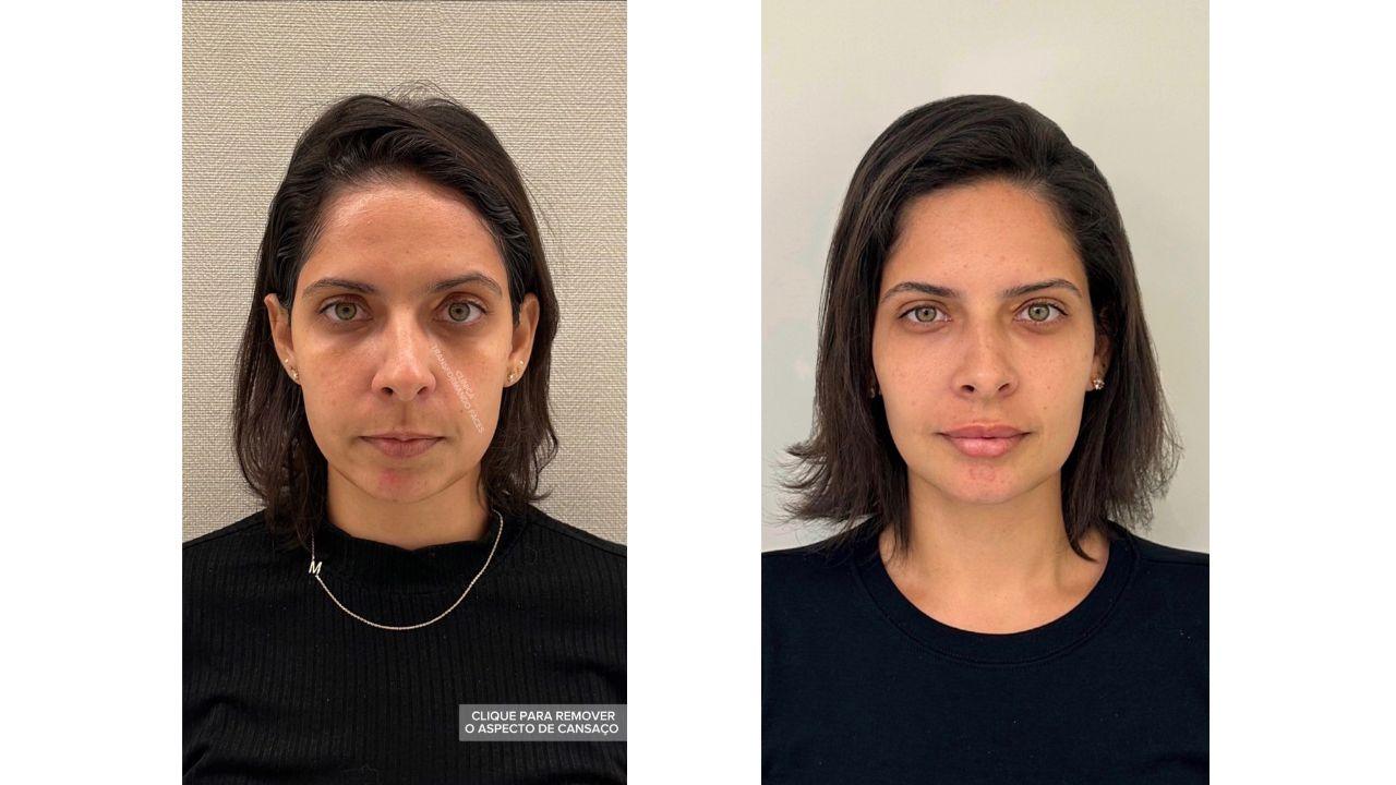 full face antes e depois full face antes e depois