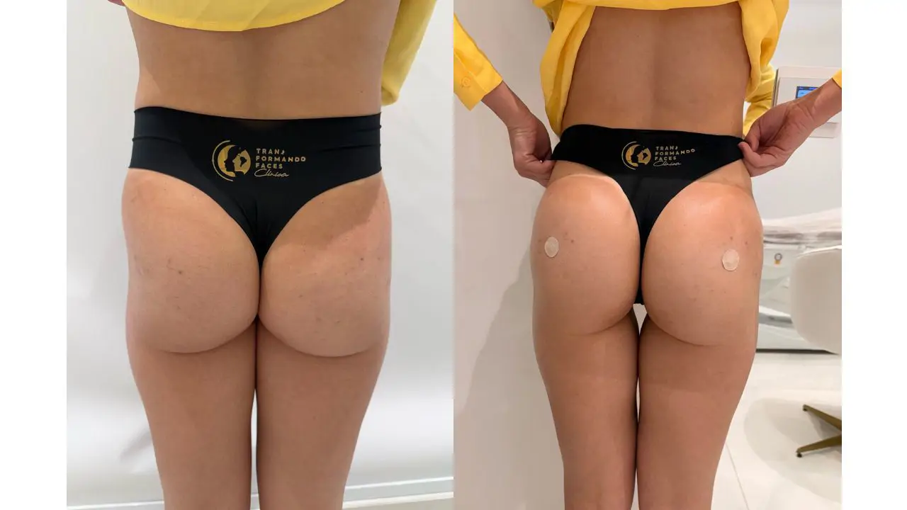glúteos antes e depois