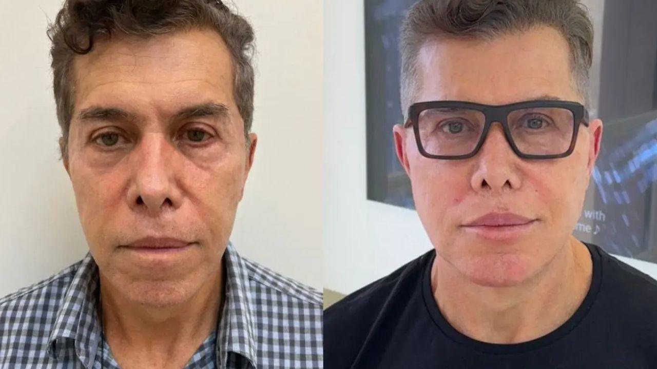harmonização facial antes e depois