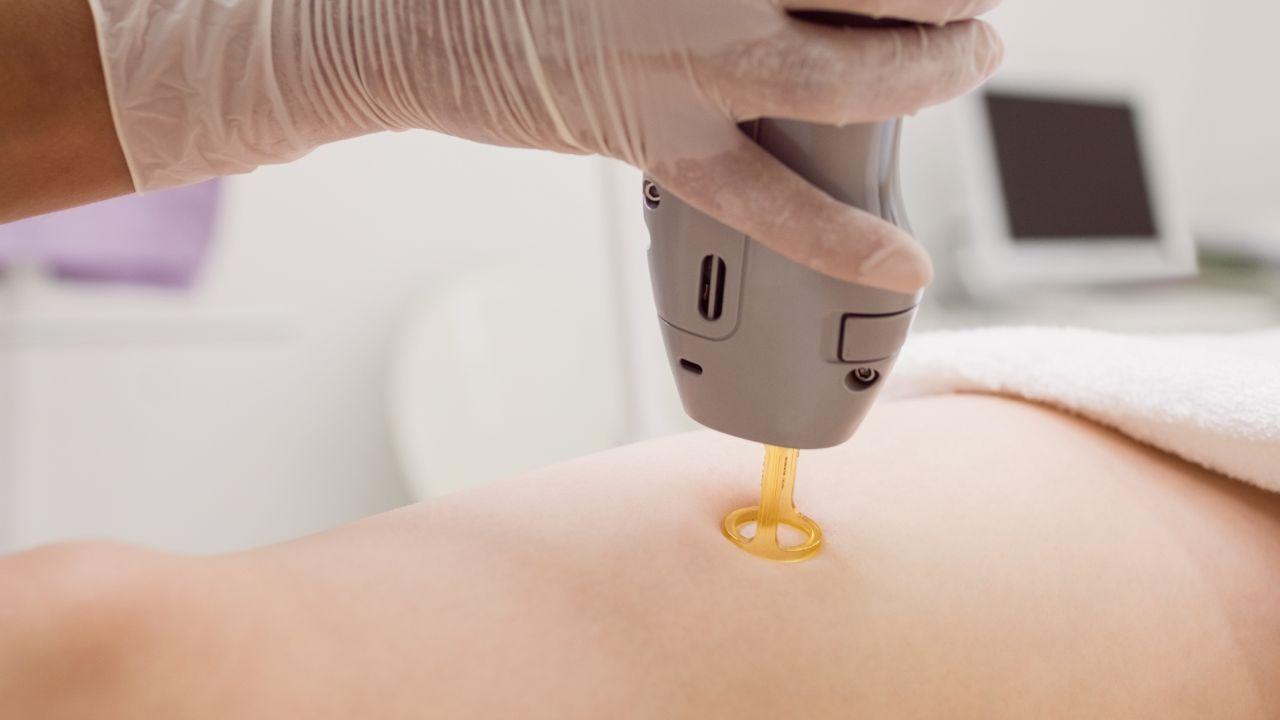 laser lavieen antes e depois laser lavieen antes e depois