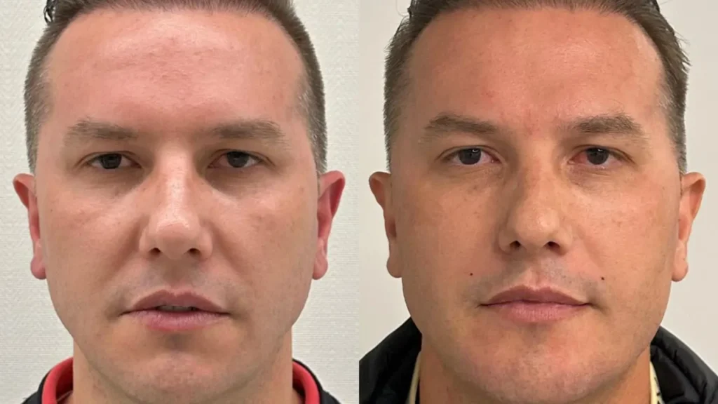 preenchimento antes e depois