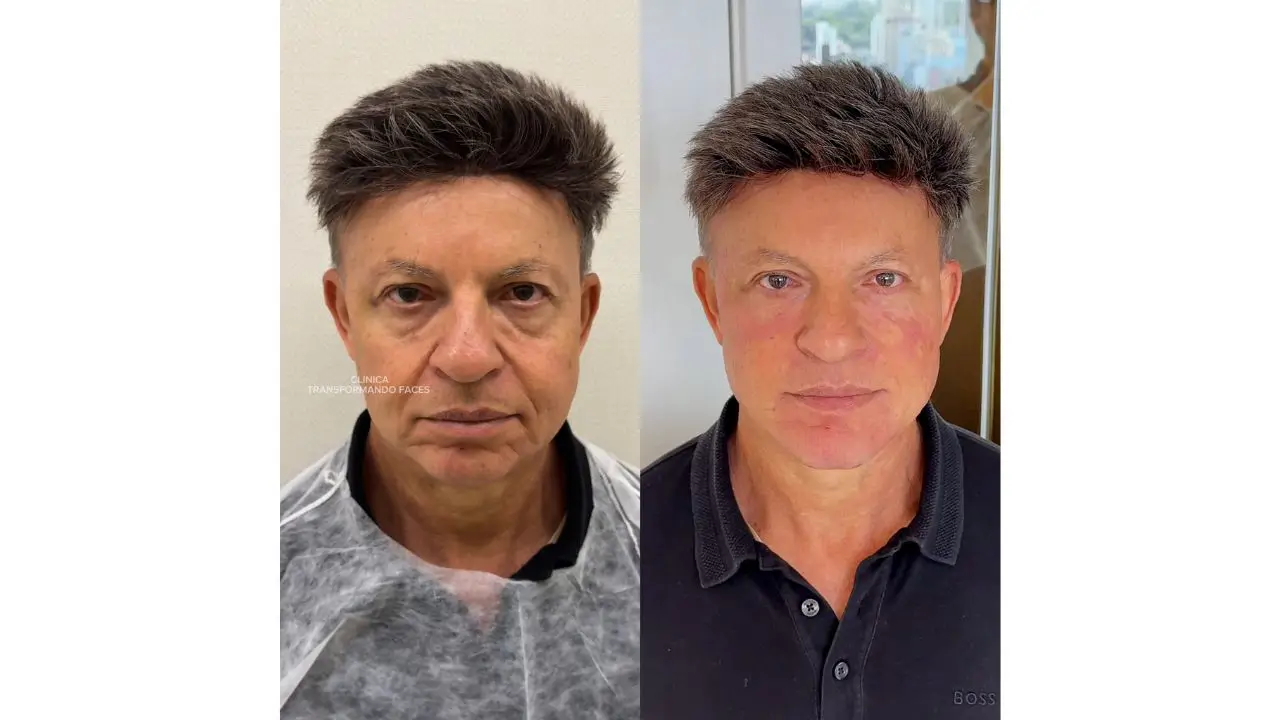 preenchimento antes e depois preenchimento antes e depois