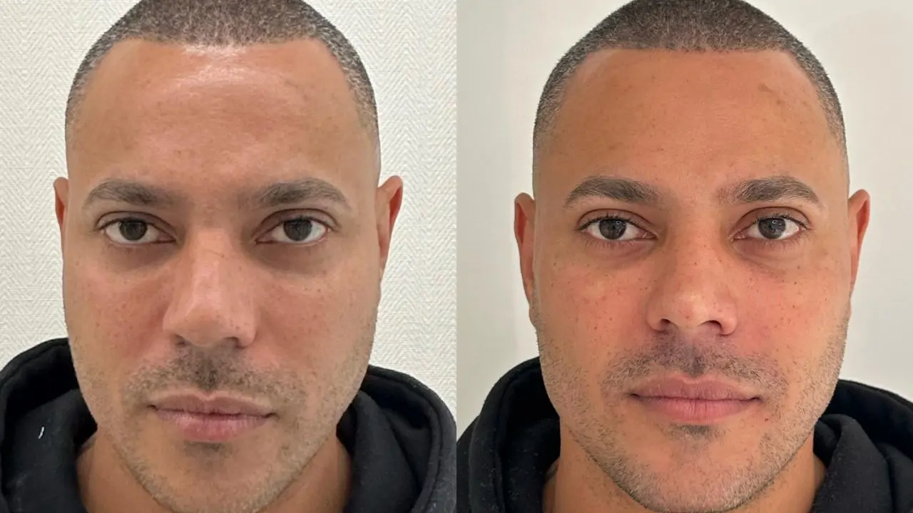 preenchimento antes e depois