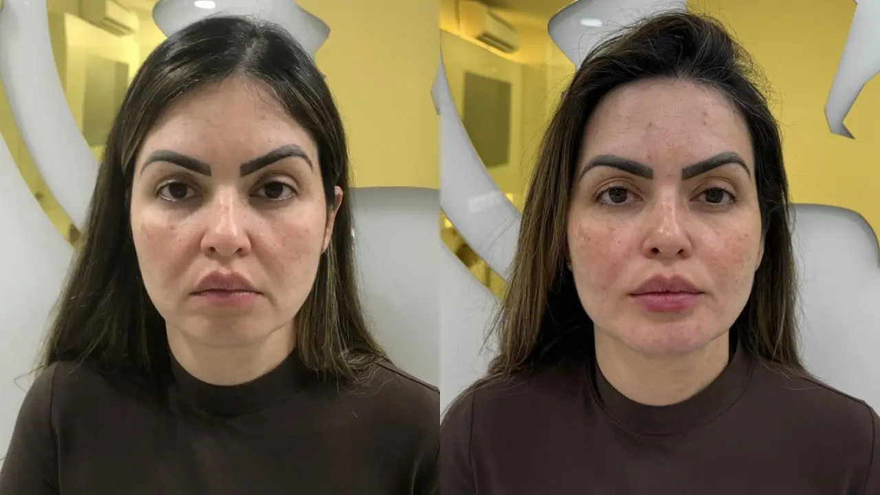 preenchimento antes e depois
