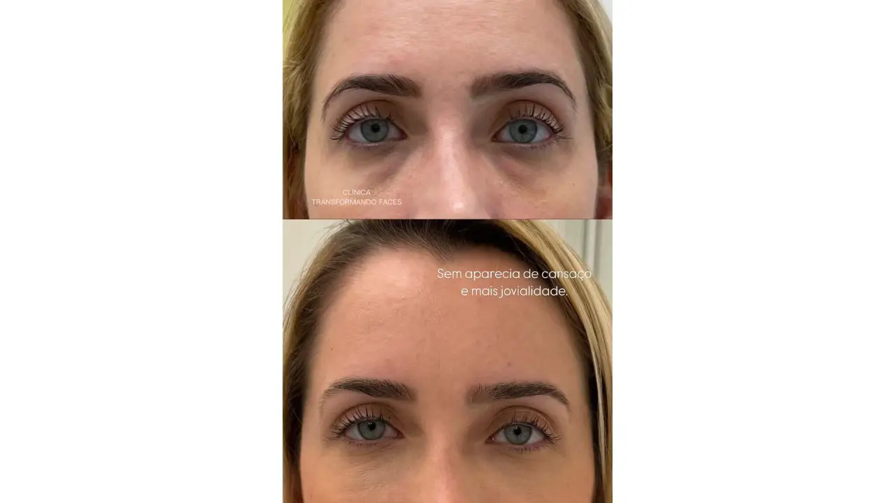 preenchimento antes e depois