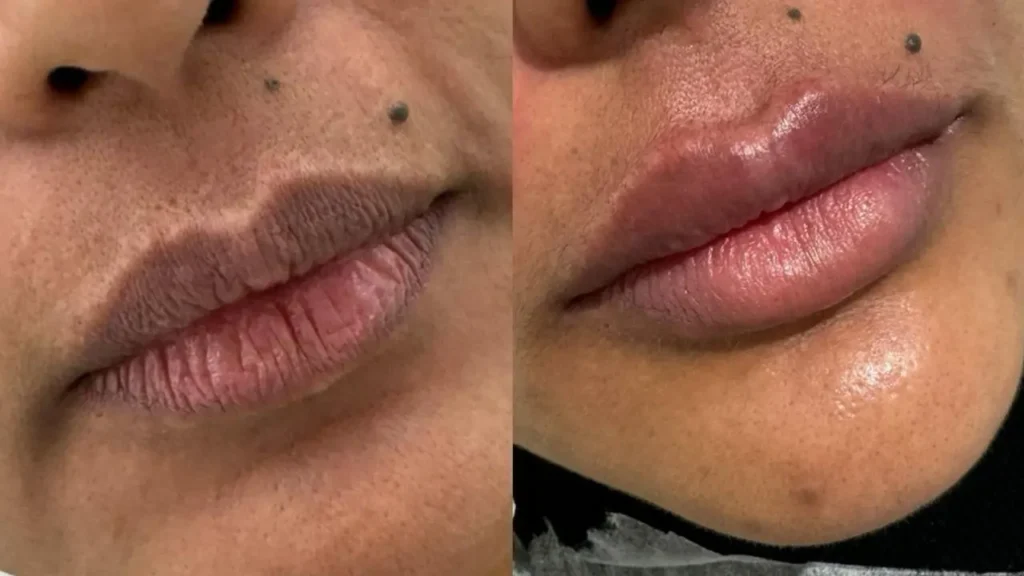preenchimento labial antes e depois