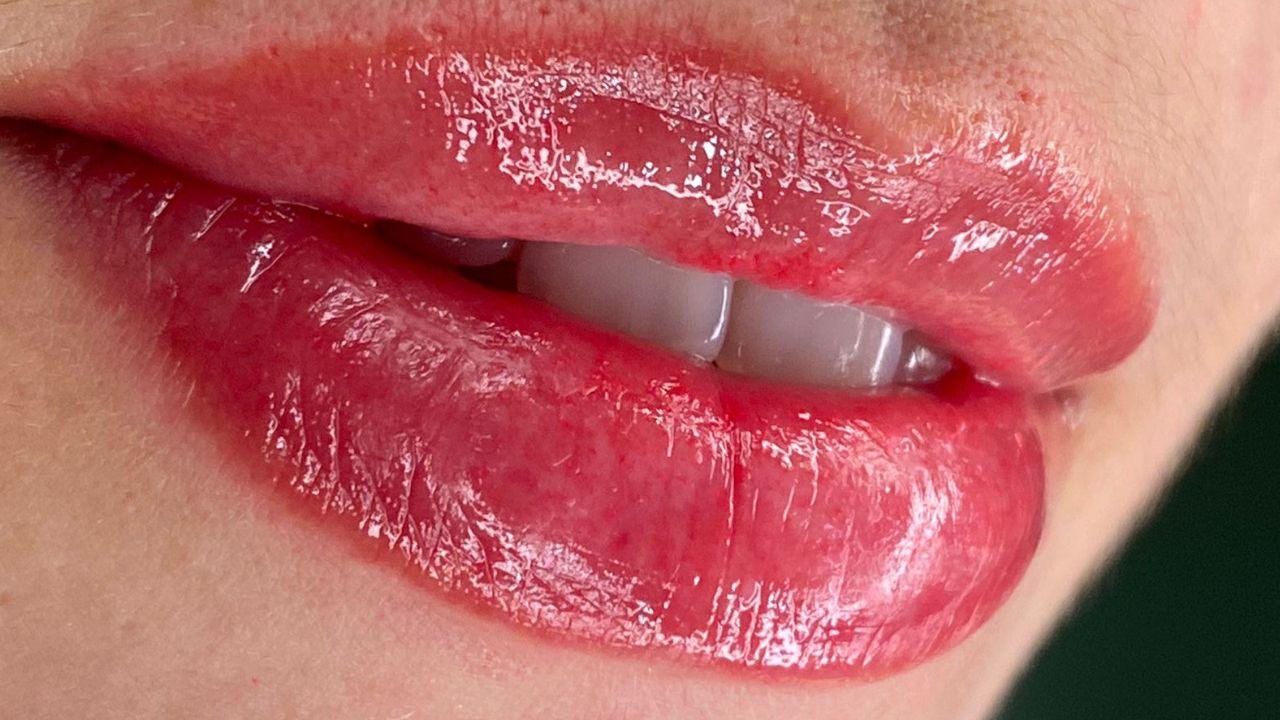 preenchimento labial antes e depois preenchimento labial antes e depois