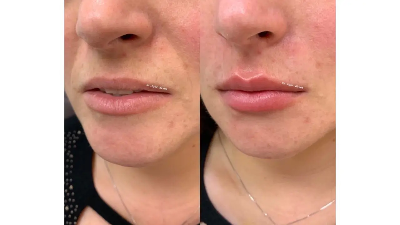 preenchimento antes e depois