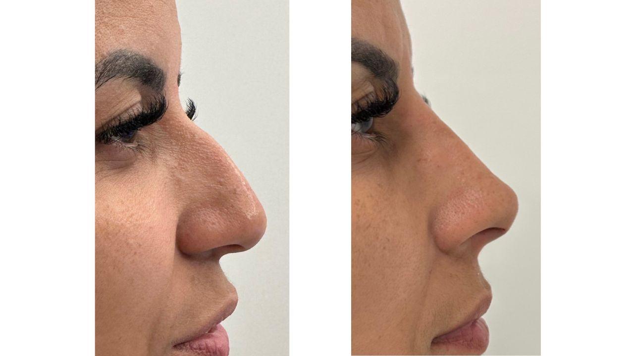 rinomodelação antes e depois rinomodelação antes e depois