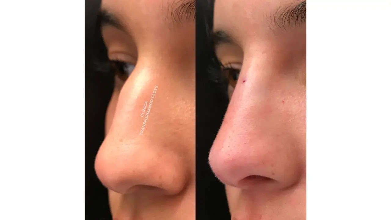 preenchimento antes e depois