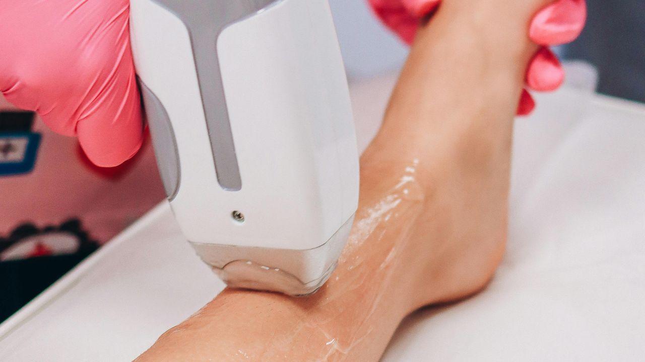 ultrassom microfocado antes e depois ultrassom microfocado antes e depois