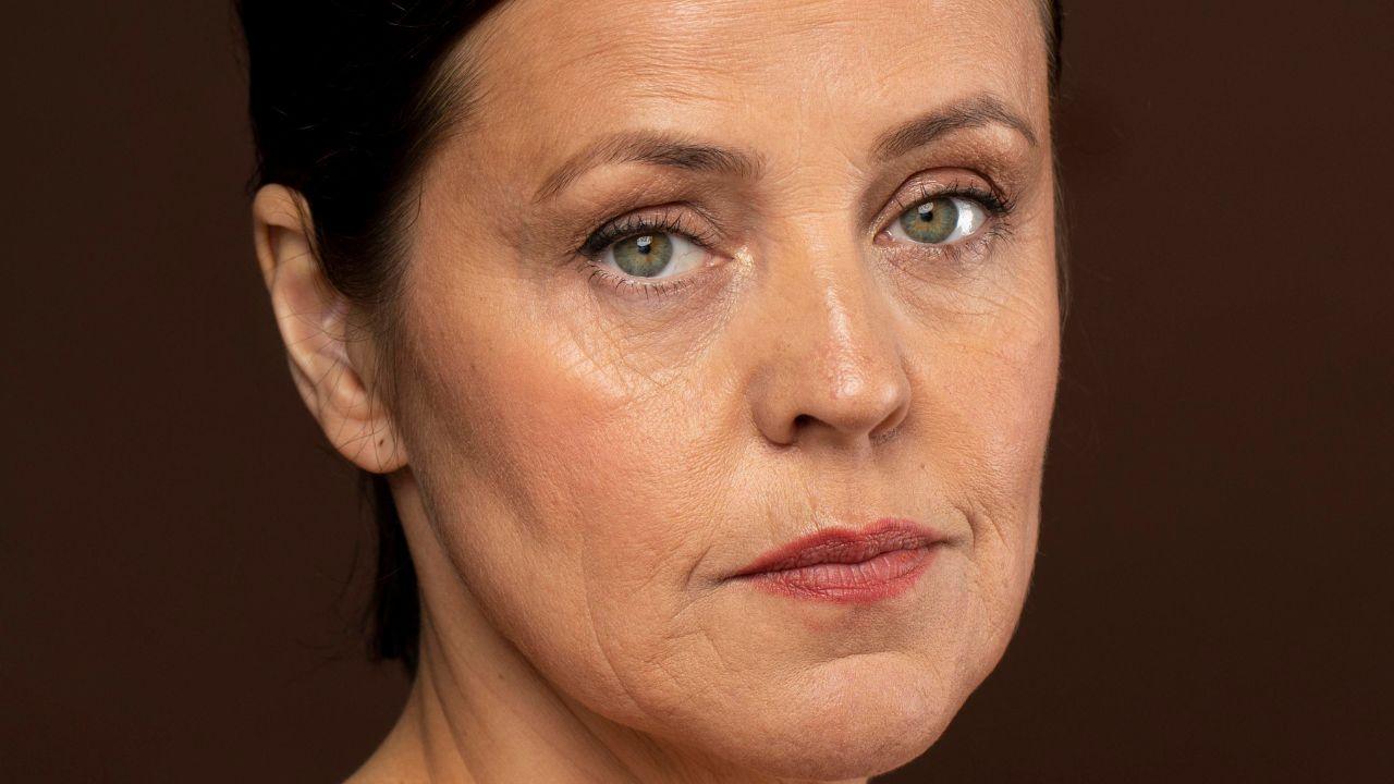 Flacidez no rosto Flacidez no rosto