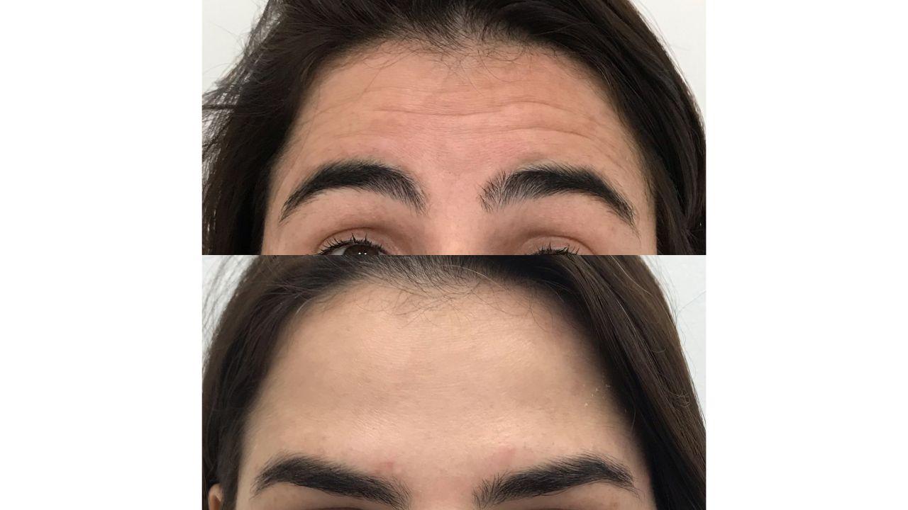botox na testa antes e depois