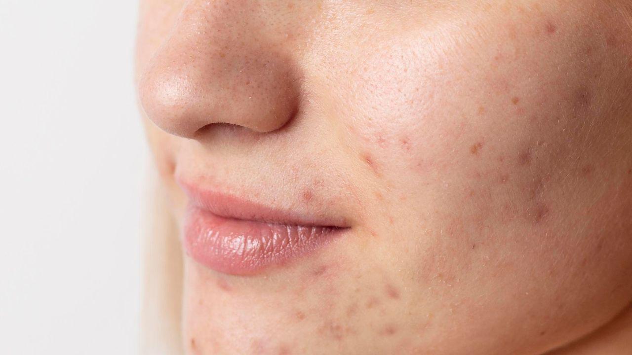cicatrizes de acnes cicatrizes de acnes