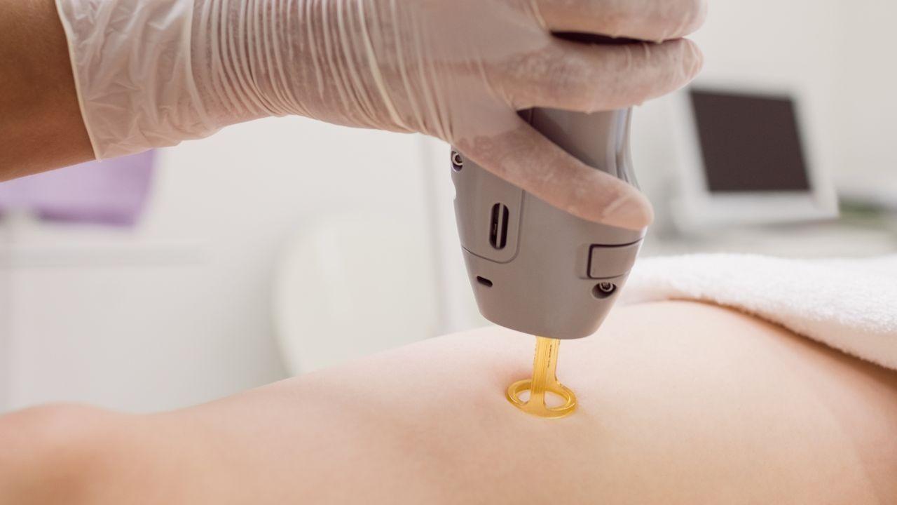 laser co2 fracionado