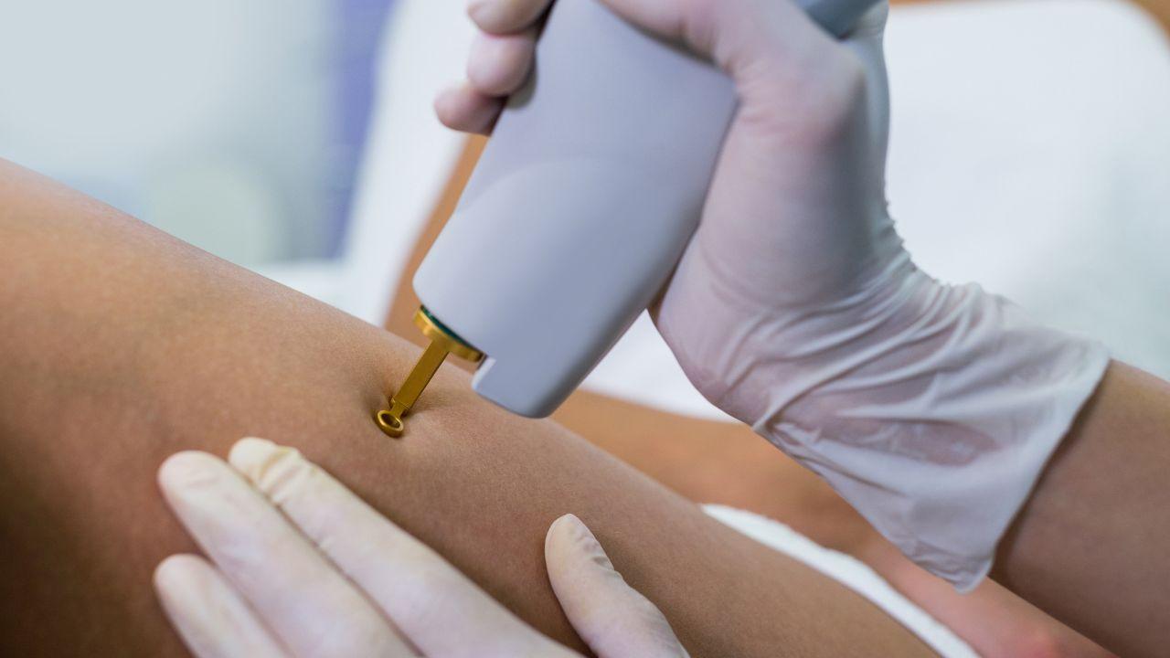 laser de co2 fracionado